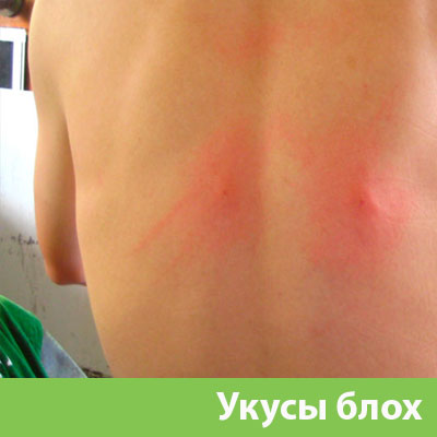 Укусы блох в Туле