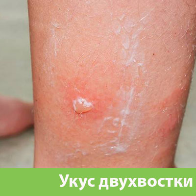 Укус двухвостки в Туле