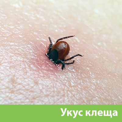 Укус клеща в Туле