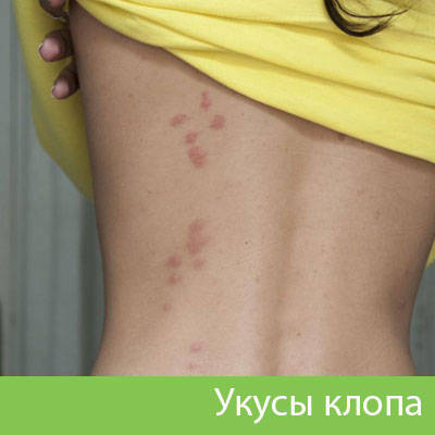 Профессиональное уничтожение клопов в Туле